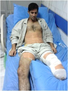 Hassan Mohammadi, wounded in fourth missile attack against Camp Liberty, has lost one of his legs